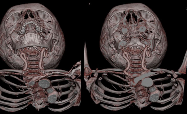 Tortuous Carotid Arteries